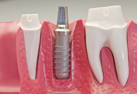 implantacia-zubov
