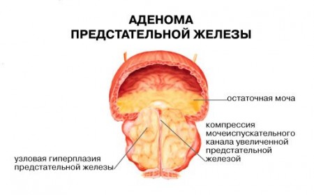 adenoma_prostati