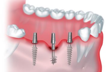 Bazalnaia-implantatciia-zubov-otzyvy-360x241